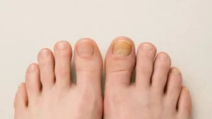 Fungal Nail Infection
