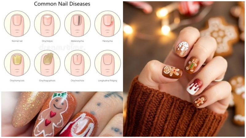 Gingerbread Nails Disease