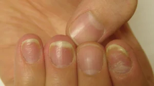 Psoriatic Nail Disease